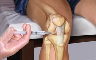 injecție intraarticulară în articulație pentru artroză
