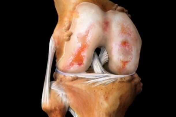 afectarea cartilajului în artrozele genunchiului