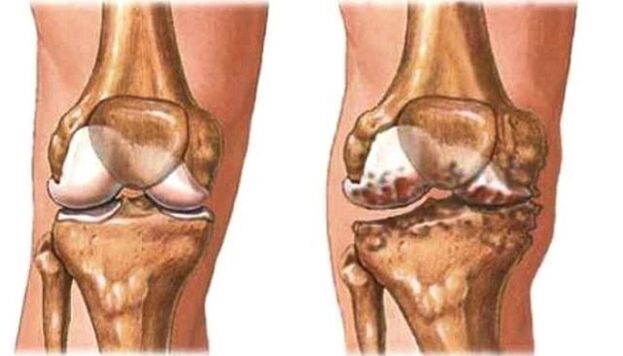 genunchi sănătos și artroza genunchiului