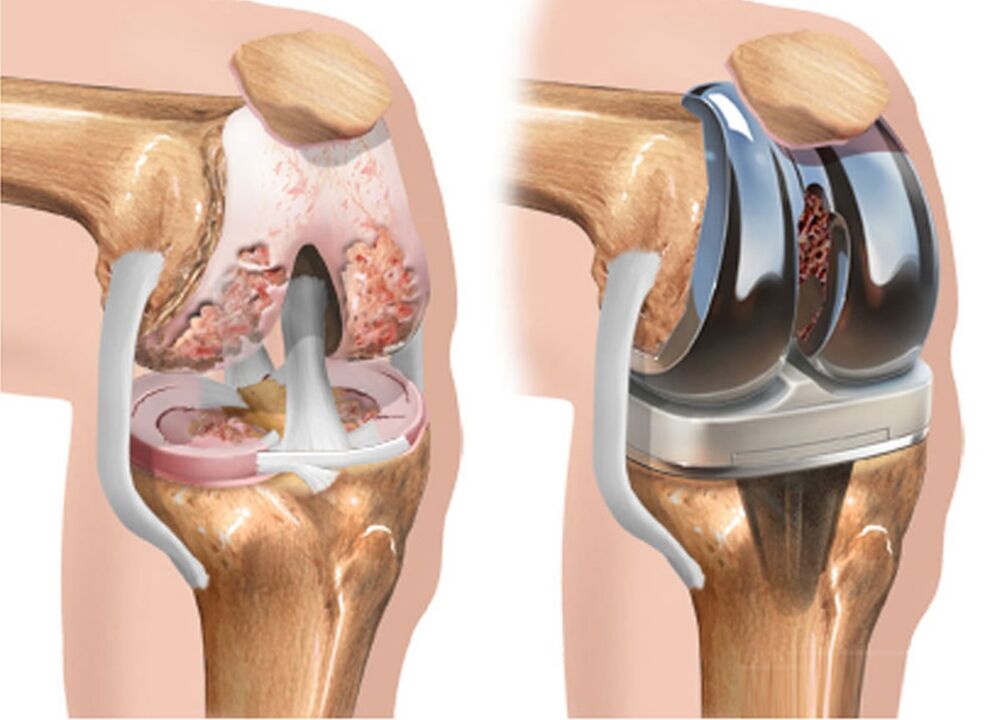 înainte și după artroză a articulației genunchiului pentru artroză