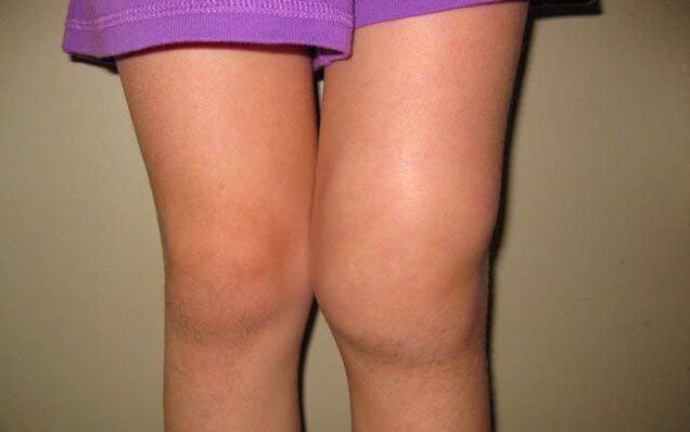 articulația genunchiului umflat din cauza osteoartritei