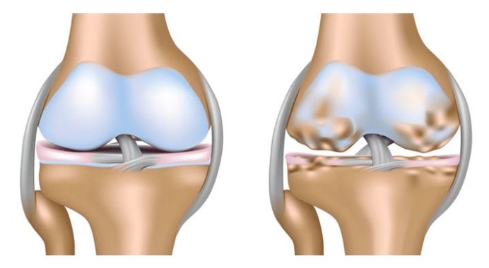 cartilaj sănătos și afectarea articulației genunchiului cu artroză