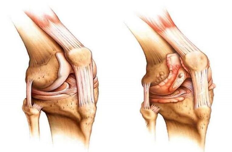 genunchi sănătos și artroza articulației genunchiului