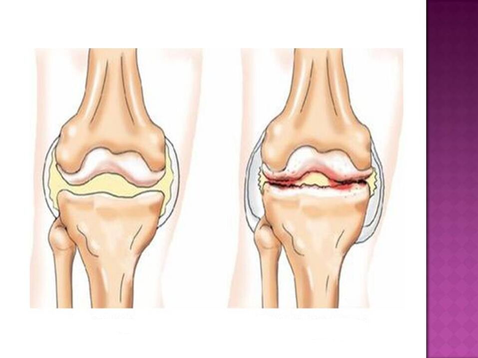 Articulația este normală (stânga) și afectată de osteoartrită (dreapta)