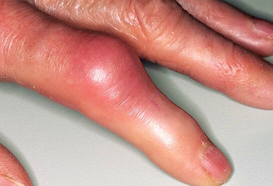 Guta este însoțită de dureri ascuțite la degete și umflarea articulațiilor. 