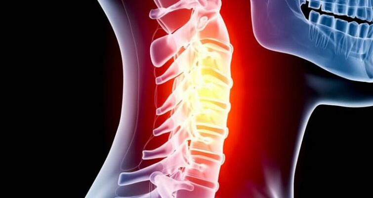 Inflamarea regiunii cervicale