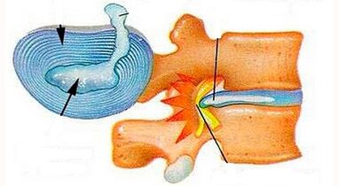 Caracteristici ale dezvoltării osteochondrozei cervicale